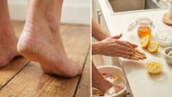 Heal Painful Cracked Heels Faster at Home Using Powerful Kitchen Ingredients That Actually Work